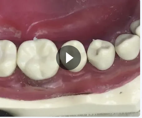 Technical PFM Preparation on Tooth 26 (Model)