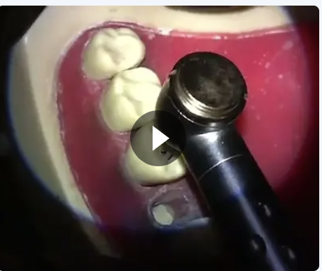 Technical Endodontic Access Opening on Tooth 26 (Model)