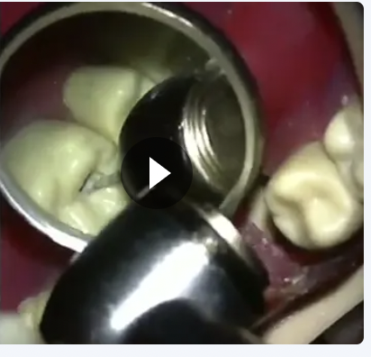 Technical Endodontic Access Opening on Tooth 16 (Manikin)