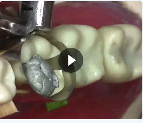 Technical Amalgam Filling on Tooth 46 (Model)