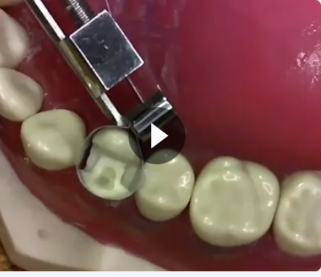 Technical Amalgam Filling on Tooth 24 (Model)