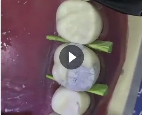 Technical Amalgam Filling on Tooth 16 (Model)