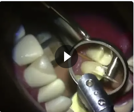 Technical Composite restoration on Tooth 15 (Manikin)
