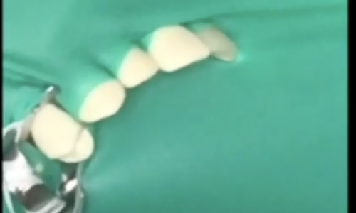Skilled OSCES Rubber Dam with One Missing Tooth